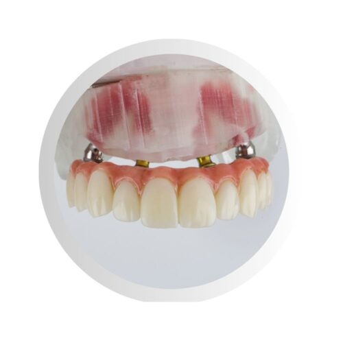 All-on-4 – nuotolinė konsultacija dėl  implantacijos