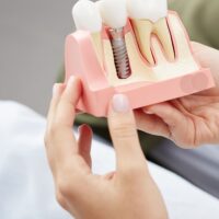 dantu-implantacija-nuotoline-konsultacija
