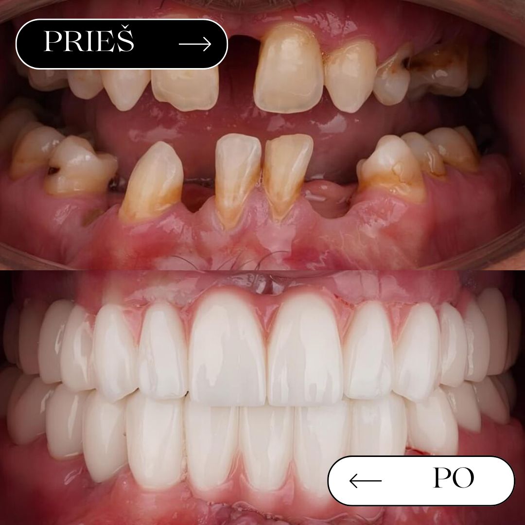 Prieš ir po – vieno danties atkūrimas implantu