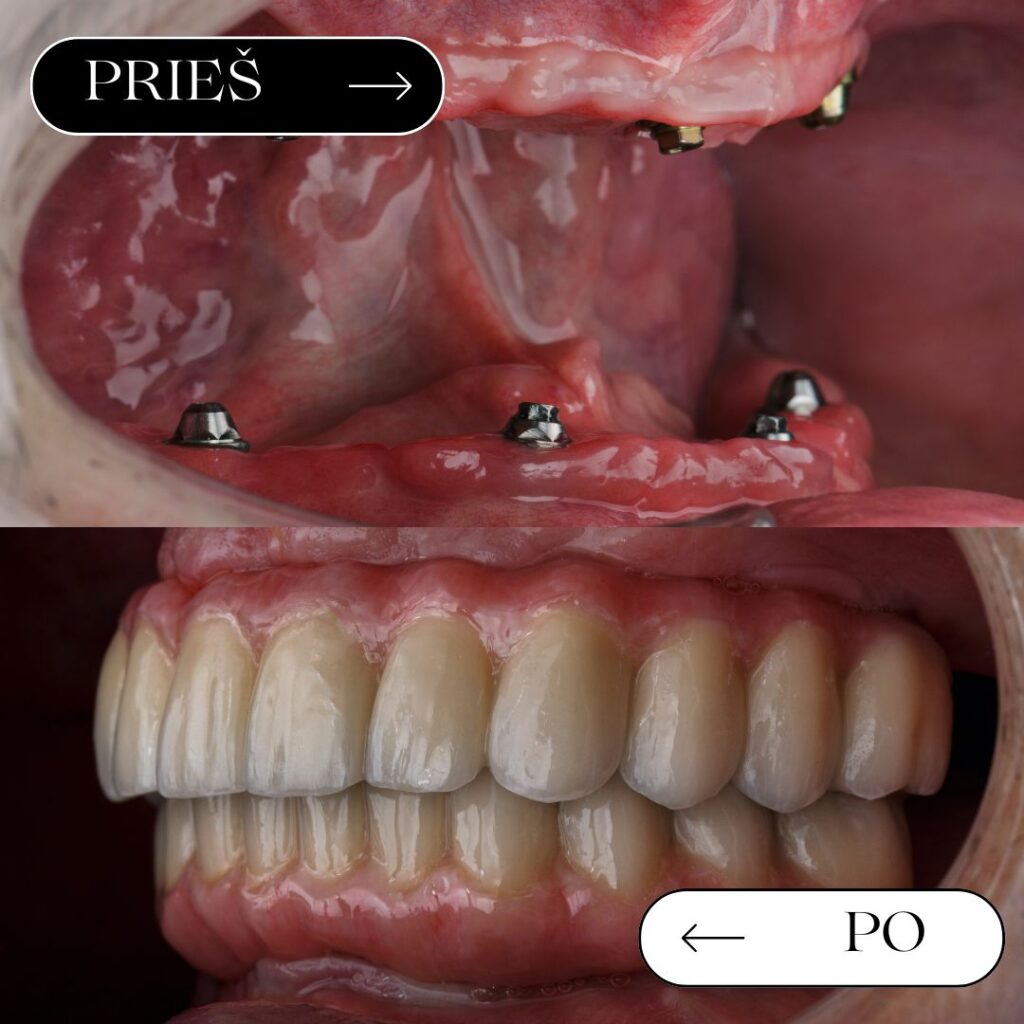All-on-4 implantacija – prieš ir po | MDENT