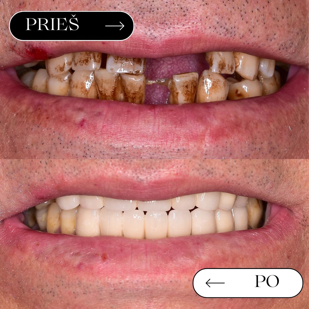 Prieš ir po – pilnas žandikaulio atkūrimas