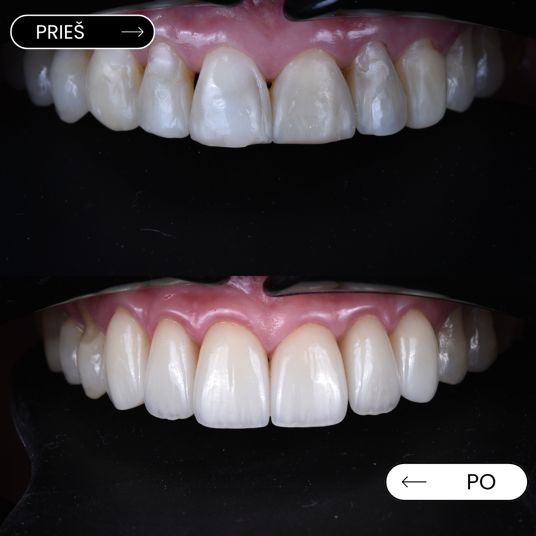 Emalio nusidėvėjimas