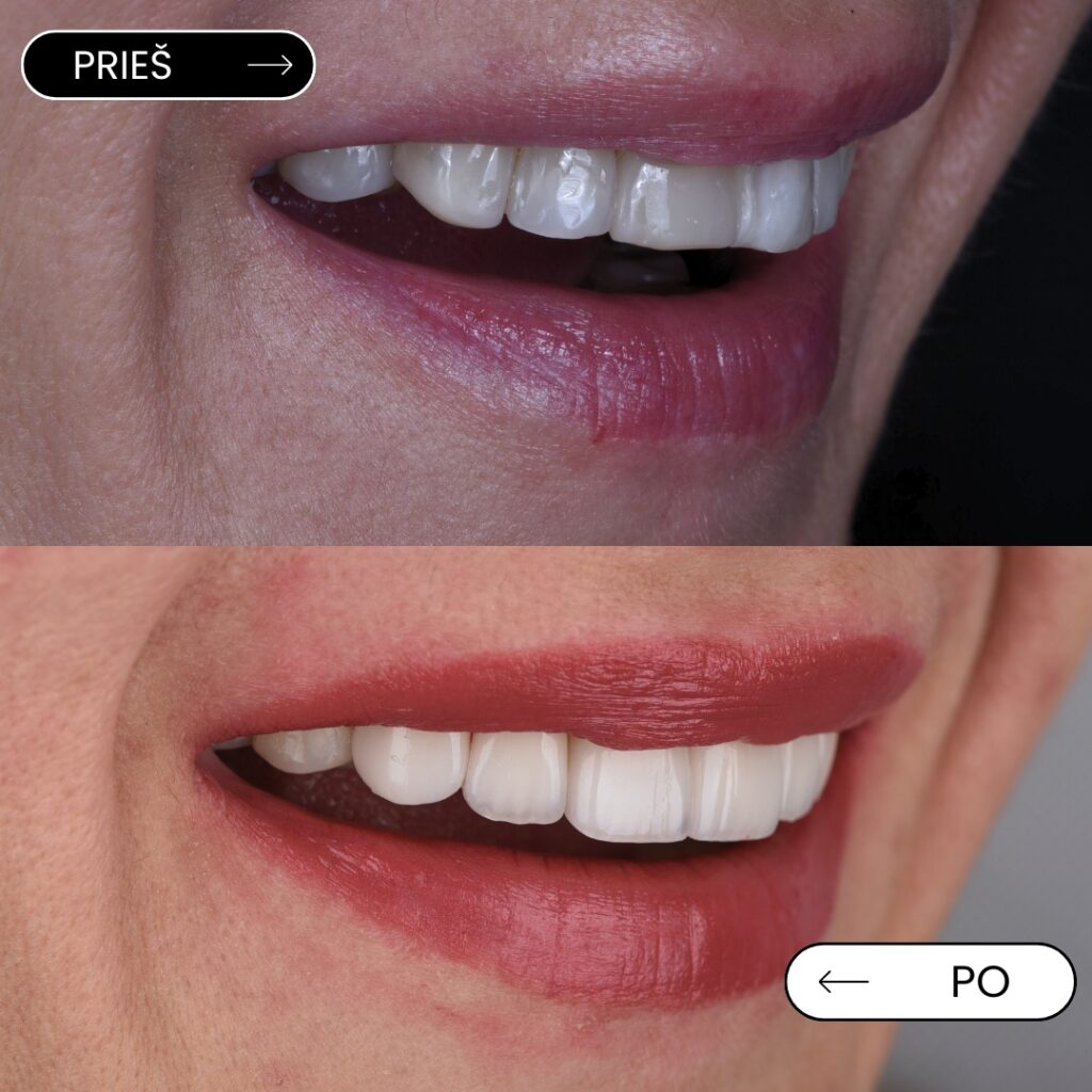 Estetinės odontologijos procedūra – dantų laminatės