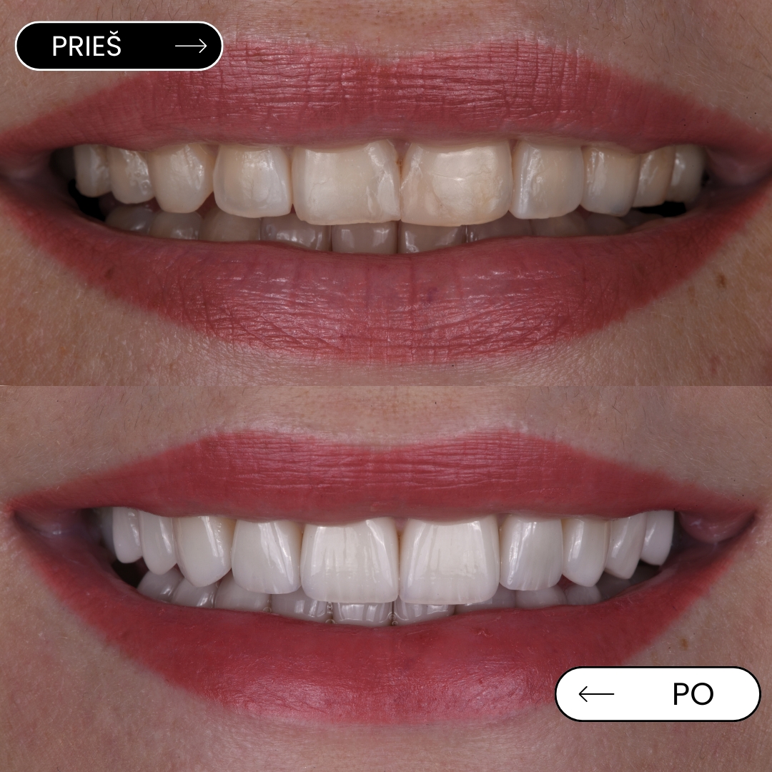 Prieš ir po – laminatės