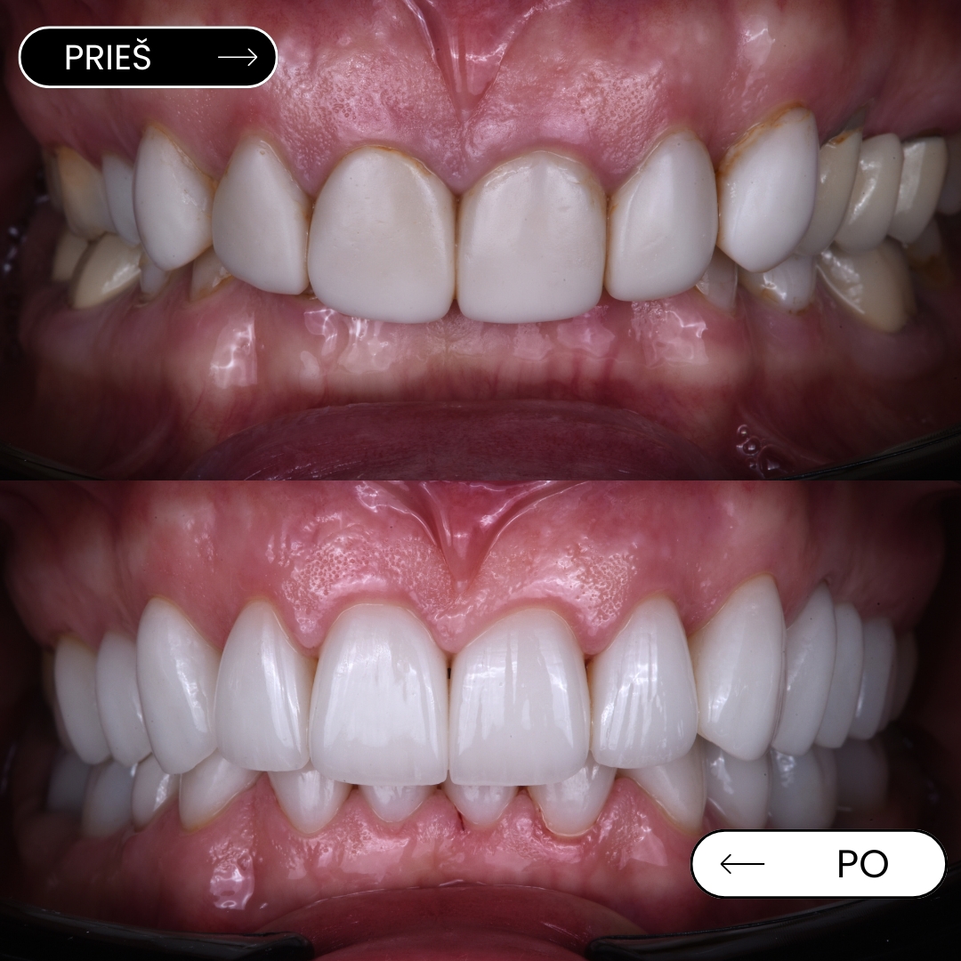 Prieš ir po – laminatės