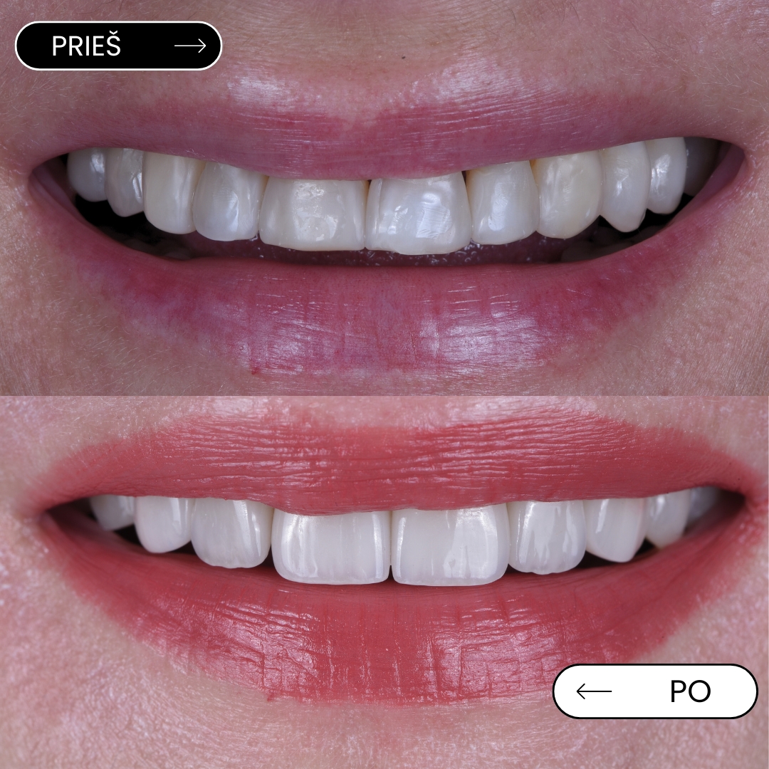 Prieš ir po – laminatės