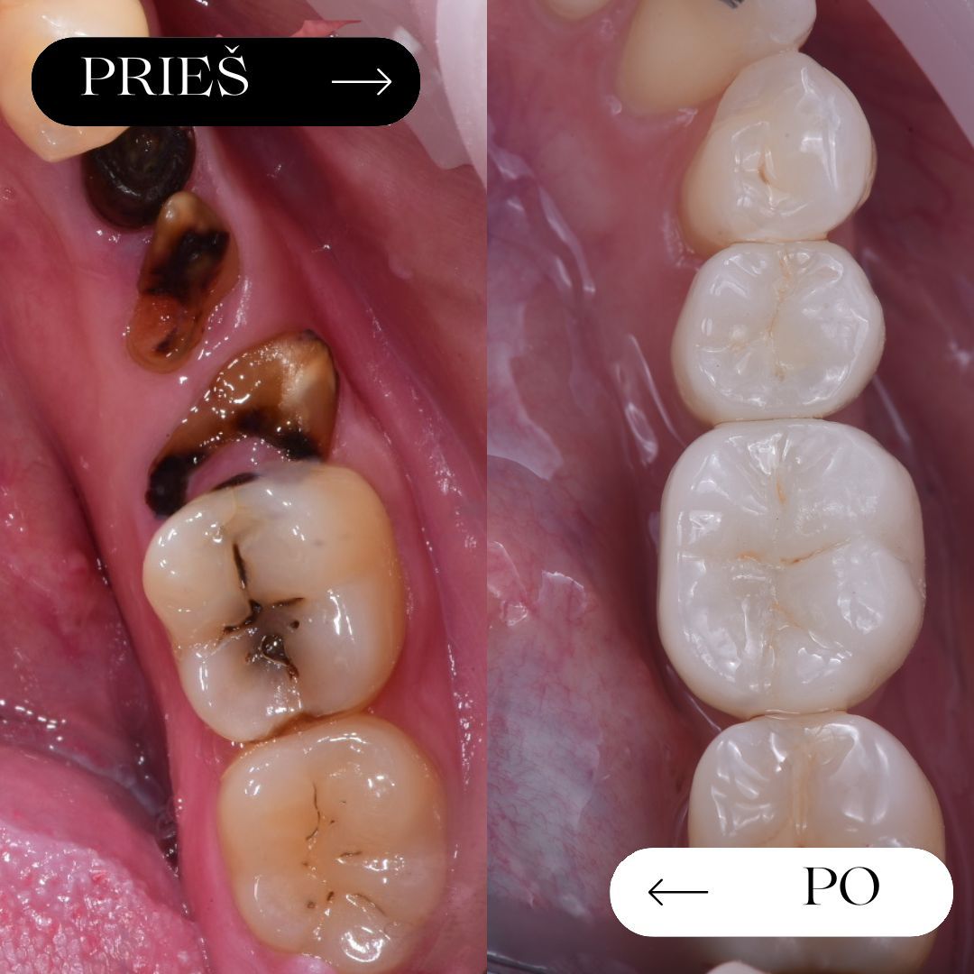 Po – vienas implantas