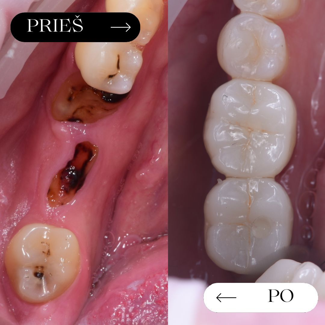 Prieš – vienas implantas