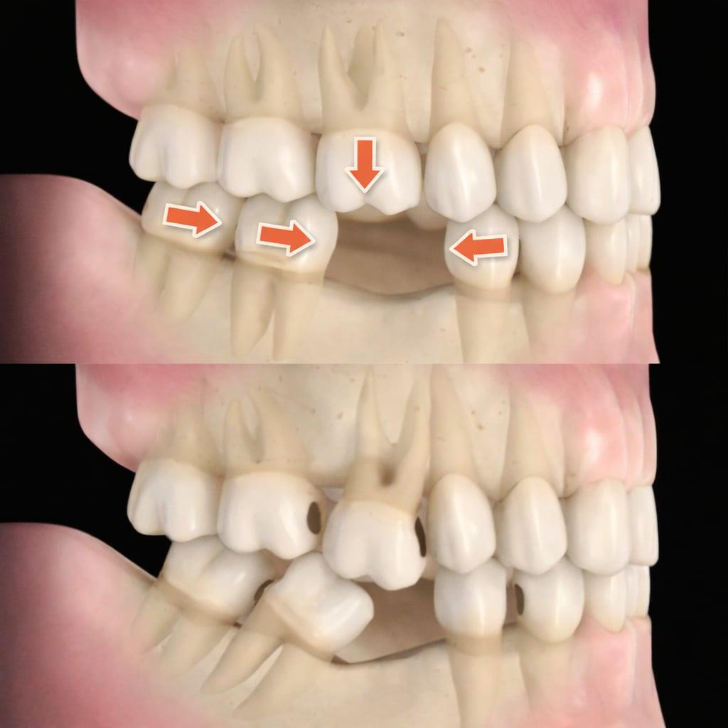 Dantų poslinkiai dėl trūkstamo danties
