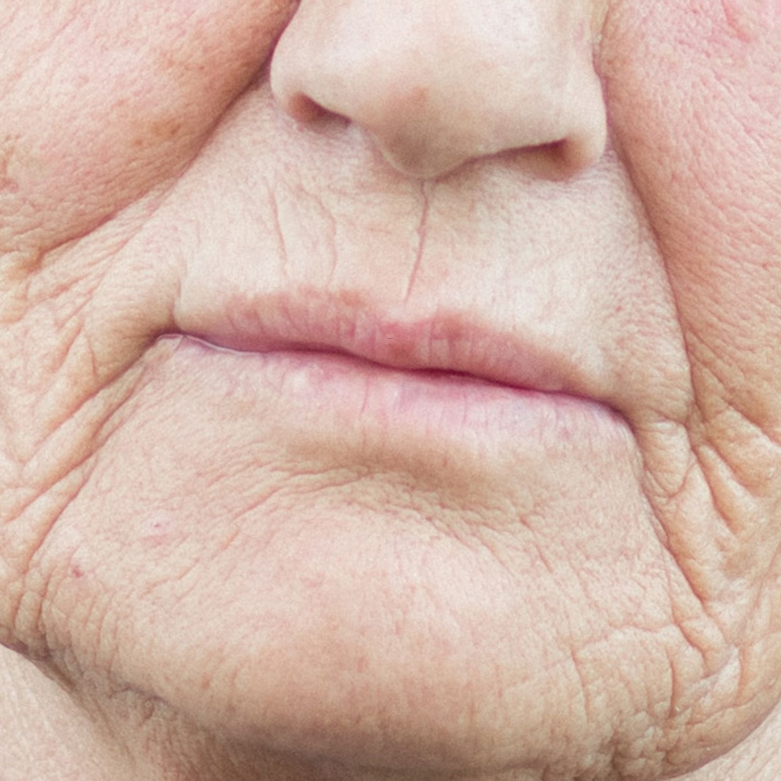 Veido pokyčiai dėl dantų netekimo